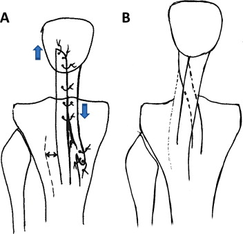 Figure 3 for case Soft tissue patellar-lowering procedure